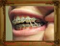 30334_Rubber_Band_for_Braces.